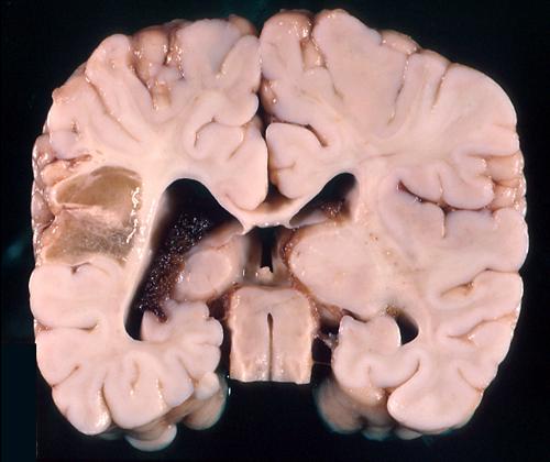 Порэнцефалия головного мозга
